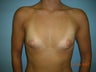 Breast Augmentation