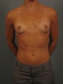 Breast Augmentation