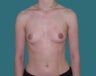 Breast Augmentation - Mammaplasty