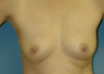 Bilateral Breast Augmentation
