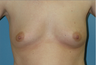 Breast Implants