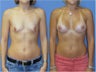 Breast Augmentation