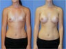 Breast Implants