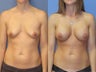 Breast Augmentation