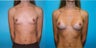 Breast Augmentation