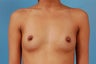 Breast Augmentation