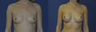 Breast Augmentation