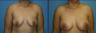 Breast Augmentation