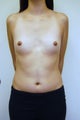 Breast Augmentation 