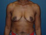 Breast Augmentation
