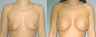 Breast Implants