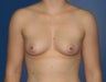 Breast Augmentation