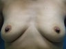 Breast Augmentation