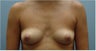 Subfascial Breast Augmentation
