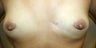 Breast Augmentation