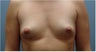 Subfascial Breast Augmentation