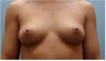 Subfascial Breast Augmentation
