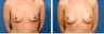 Breast Augmentation