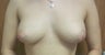 Breast Augmentation