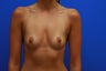 Breast Augmentation