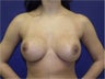 High Profile, Style 45, 800cc Silicone Gel Breast Implants