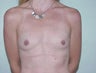 Breast Augmentation