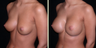 Breast Augmentation
