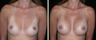 Breast Augmentation