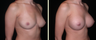 Breast Augmentation 