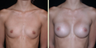 Breast Augmentation