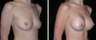 Breast Augmentation