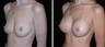 Breast Augmentation