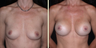 Breast Augmentation