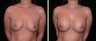 Breast Augmentation 