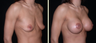 Breast Augmentation with Lift 