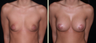 Breast Augmentation with Lift