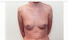 Breast Augmentation