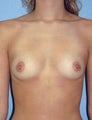 Breast Augmentation