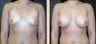 Breast Augmentation