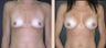 Breast Augmentation