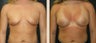 Breast Augmentation