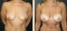Breast Augmentation