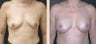 Breast Augmentation