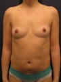 Breast Augmentation