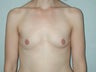 Breast Augmentation