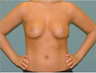 Breast Augmentation