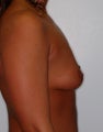 Breast Augmentation