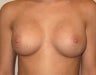 Bilateral Breast Augmentation