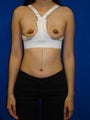 Breast Reconstruction Symmastia Repair