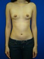 Symmastia Repair (No Implants)